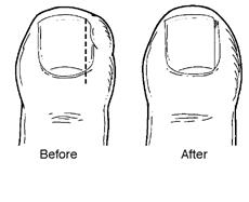 Thongs with Heels and Arch Support - Erina Podiatry