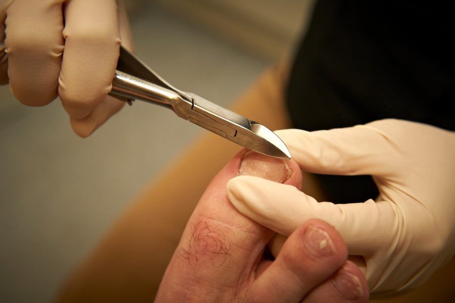 Nail and skin management - ingrown toenails